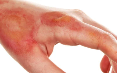 Have You Suffered From A Burn? Hand Therapy May Help.