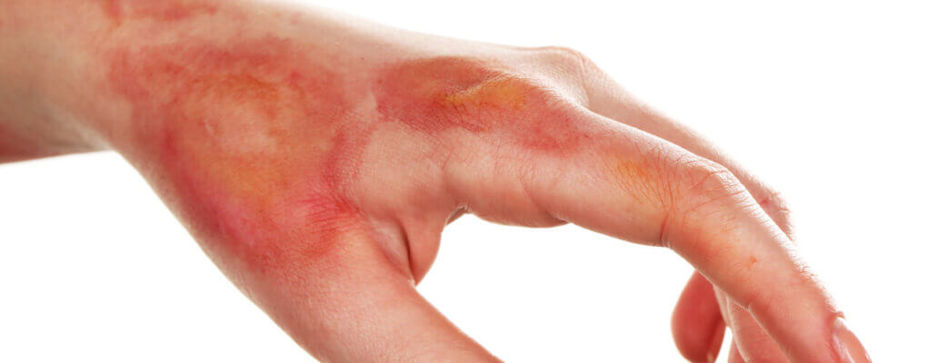 Have You Suffered From A Burn? Hand Therapy May Help.